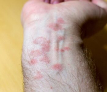 jak-wyglada-egzema-objawy-i-zdjecia