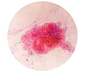 rodzaje-grzybicy-skory-zdjecia-i-przyczyny