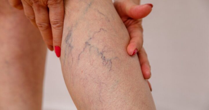 laserowe-usuwanie-zylakow---efekty-i-mozliwe-powiklania