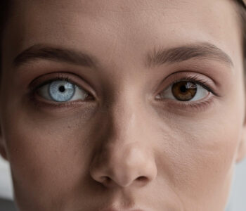 heterochromia---co-to-jest